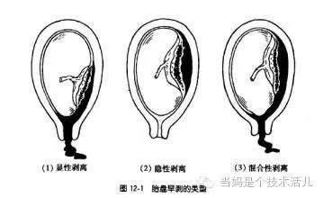 胎盤剝離原因